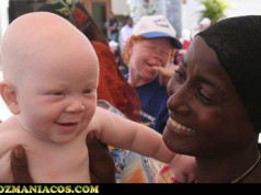 Fotos de lindos bebés africanos albinos