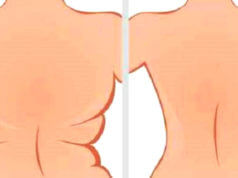 Exercícios Simples Para Eliminar a Gordura e Flacidez Nas Costas