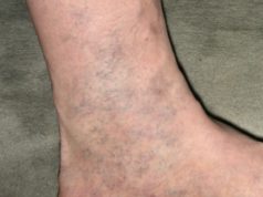 Todos têm em casa algo para curar as varizes, mas quase ninguém sabe