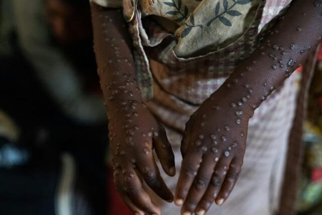 Moçambique regista mais 16 casos de mpox em 24 horas